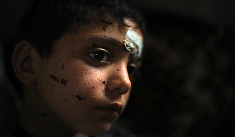 Niño sirio herido en la guerra